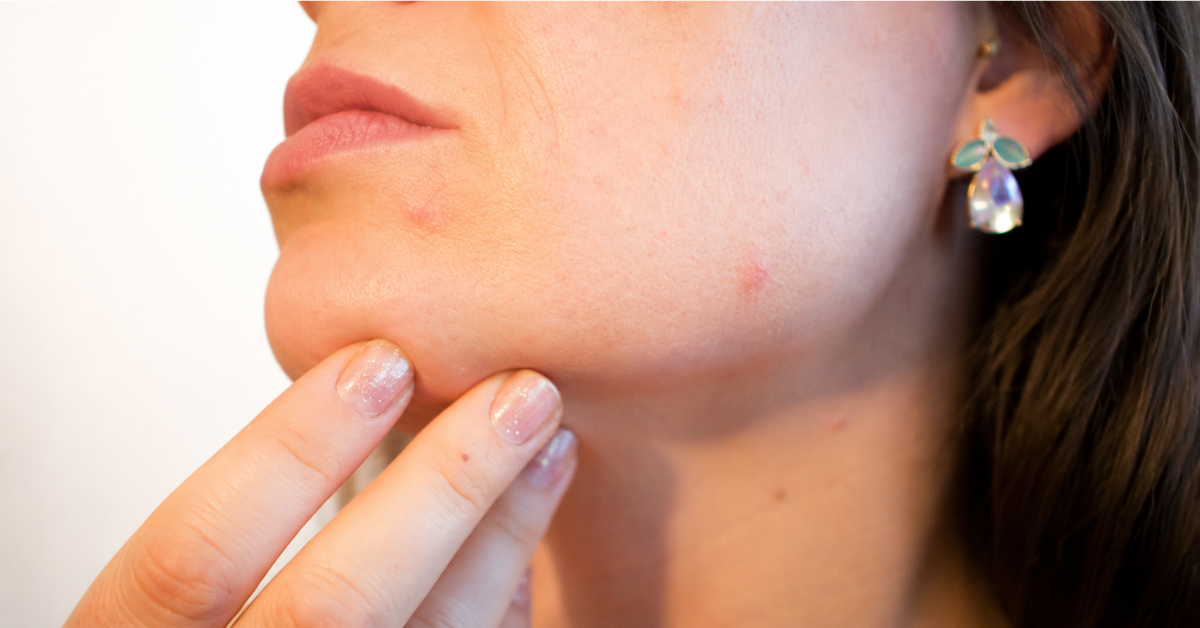 Supplements for Acne: A Guide to Detox Supplements for Clear Skin – tarsulblogs