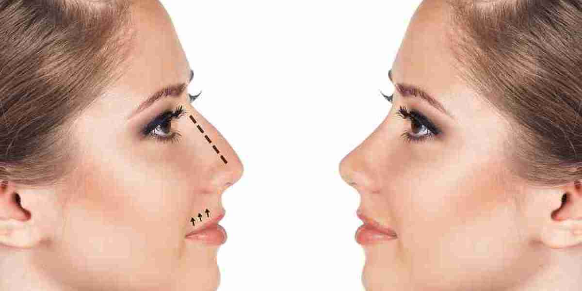What Is Closed vs Open Rhinoplasty?